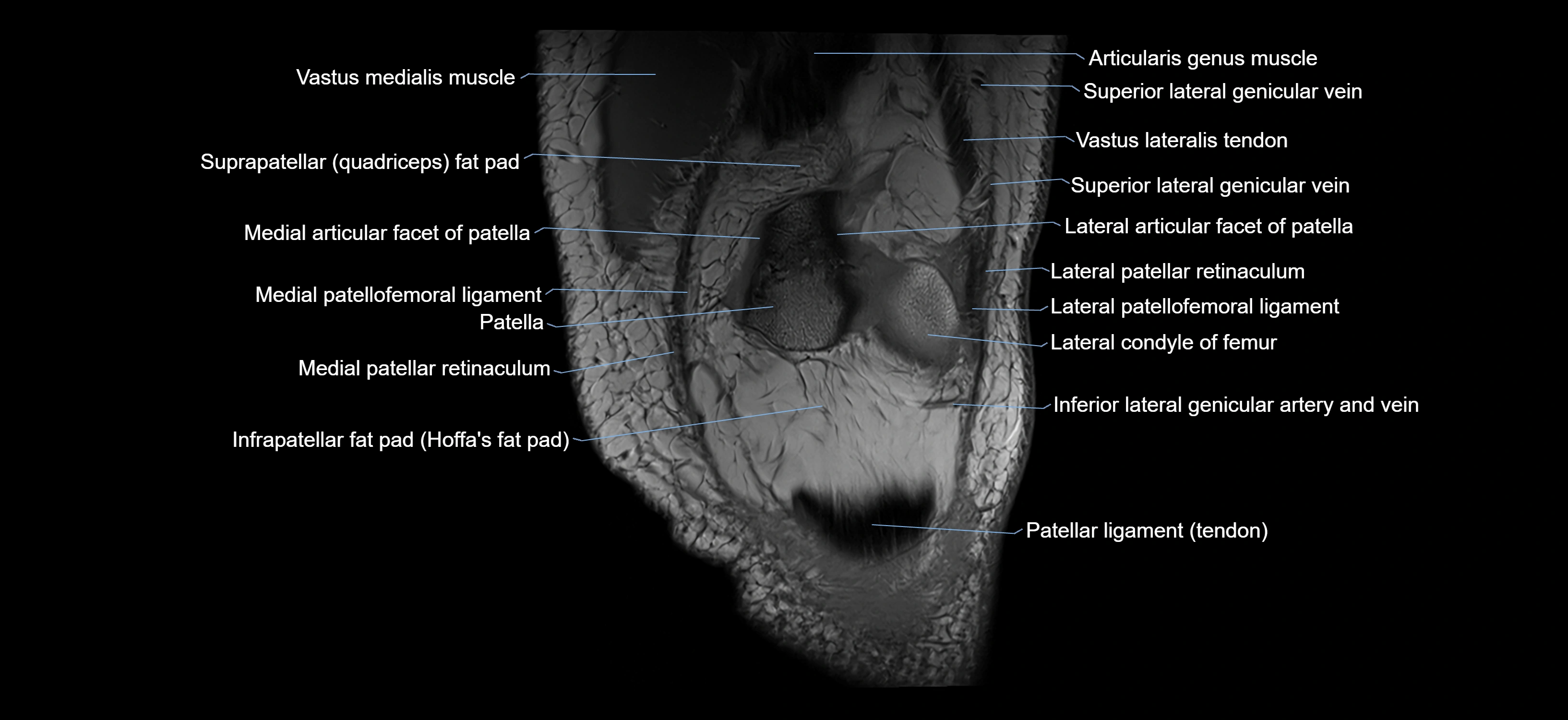 MRI knee coronal cross sectional anatomy labelled 3T radiology  image-04001-00008.webp